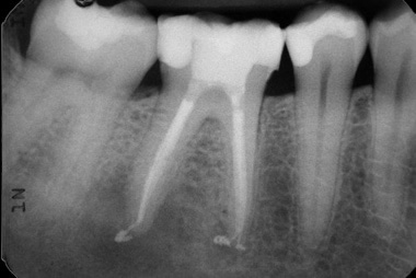 Dental Crowns